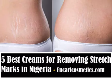 Creams for Removing Stretch Marks in Nigeria