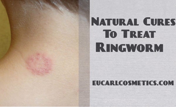 Ringworm Cure: Natural Cures To Treat Ringworm Fast
