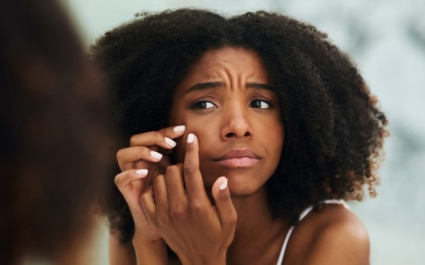 10 Best Tube Creams for Pimples in Nigeria